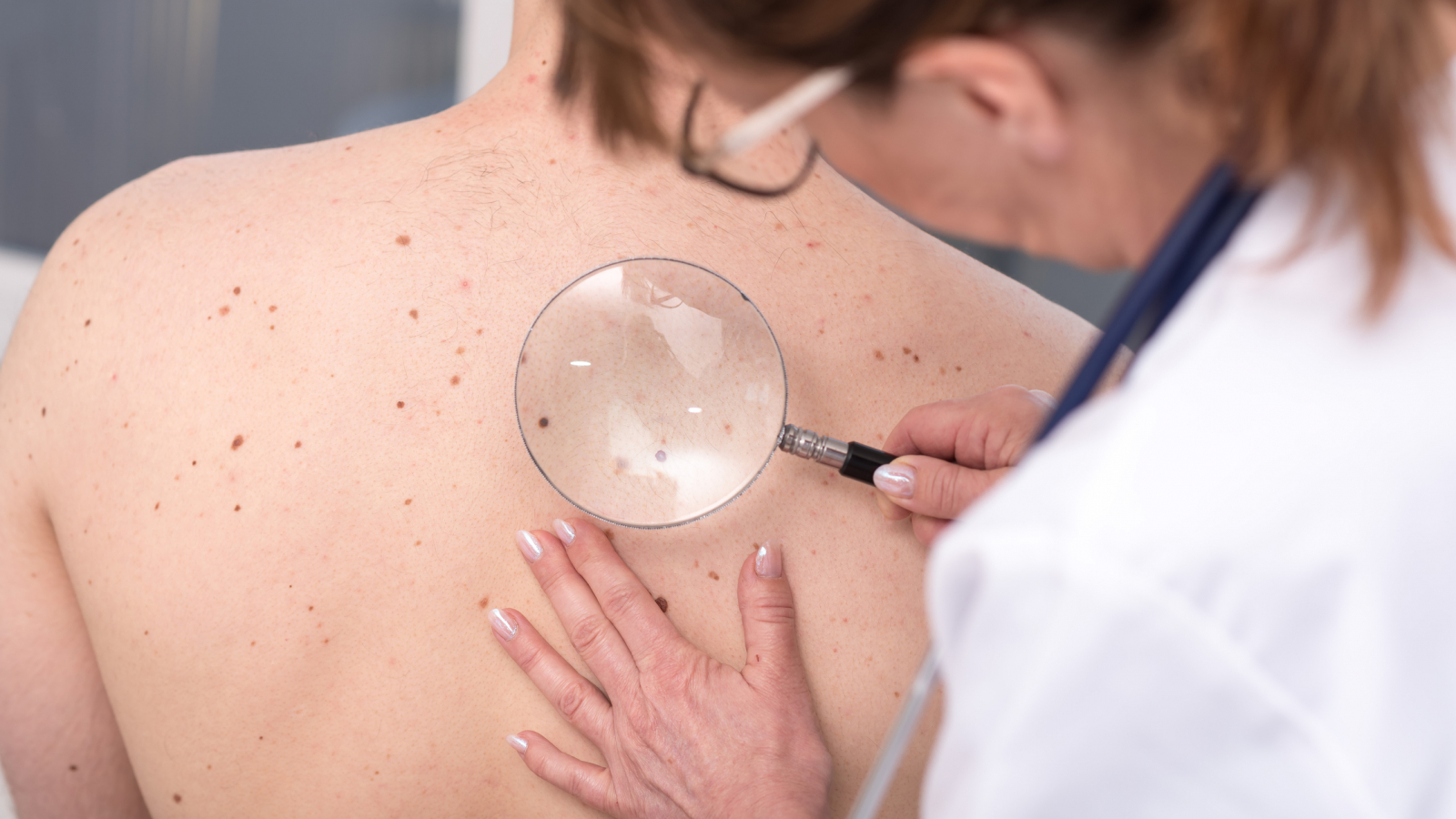 Dermatologist examining the skin on the back of a patient